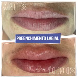 Resultado Preenchimento Labial - Brasília Sudoeste