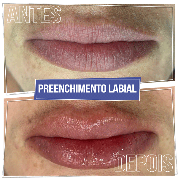 Resultado Preenchimento Labial - Brasília Sudoeste