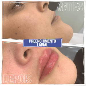 Resultado Preenchimento Labial - Brasília Sudoeste