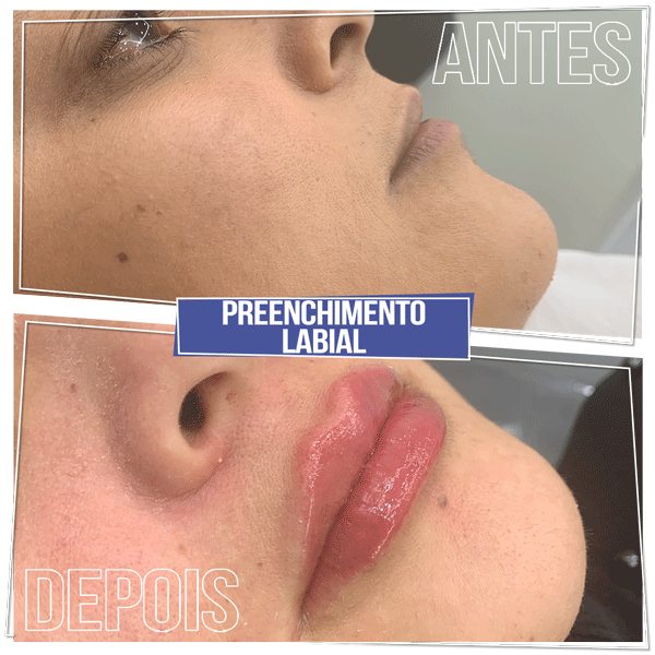 Resultado Preenchimento Labial - Brasília Sudoeste