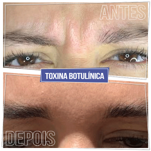 Resultado Toxina Botulínica - Brasília Sudoeste