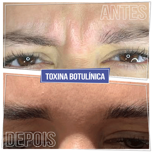 Resultado Toxina Botulínica - Brasília Sudoeste