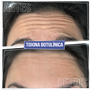 Resultado Toxina Botulínica - Brasília Sudoeste