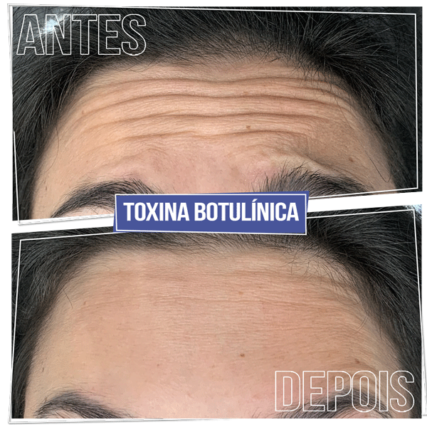 Resultado Toxina Botulínica - Brasília Sudoeste