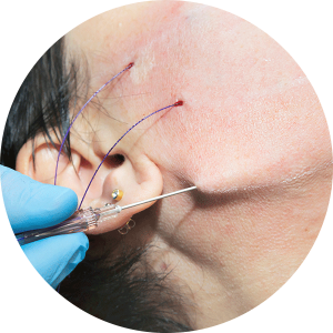 #Clínica de Estética em Brasília; #Clínica no Sudoeste; #Estética Avançada #Otomodelação; #Harmonização de Orelhas #orelhas de abano #otoplástia #Limpeza de Pele; #Dermaplaning; #Peeling de Diamante; #Peeling Zena – Facial; #Peeling Zena – Corporal; #Peeling Químico; #Microagulhamento; #Hydra Lips; #Preenchimento; #Preenchimento Labial; #Harmonização; #Fios PDO; #Bioestimulador de Colágeno – Elleva; #Bioestimulador de Colágeno – Sculptra; #Blefaroplastia Sem Corte; #Cauterização; #Lobuloplastia; #Remoção de Verrugas; #Jato de Plasma; #Marcas de Acne; #Skinbooster; #Lipo de Papada; #Intradermoterapia – Gordura Localizada; #Intradermoterapia – Celulite; #Intradermoterapia – Intramusclar; #Intradermoterapia – Capilar; #Intradermoterapia – Estrias; #Lipo de Papada – Sem Corte; #Sedação Consciente; #Sem dor; #PEIM; #Otomodelação; #harmonização de orelhas