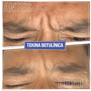Antes e Depois Toxina Botulínica - Glabela (bravo)