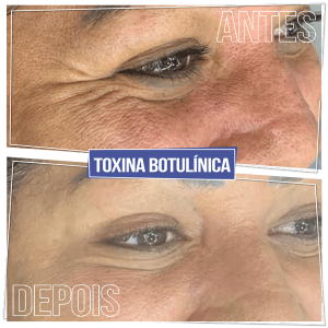 Antes e Depois Toxina Botulínica - Pés de Galinha