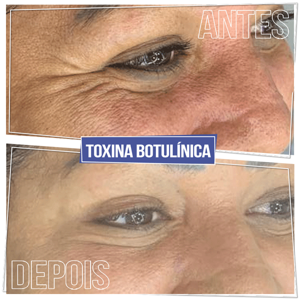 Antes e Depois Toxina Botulínica - Pés de Galinha