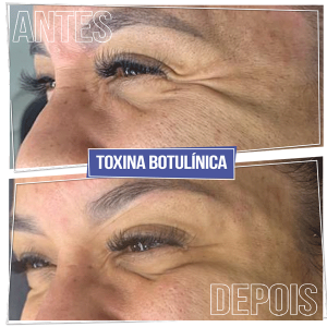 Antes e Depois Toxina Botulínica - Pés de Galinha