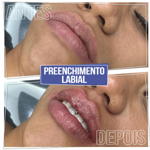 Resultado Preenchimento Labial - Brasília Sudoeste