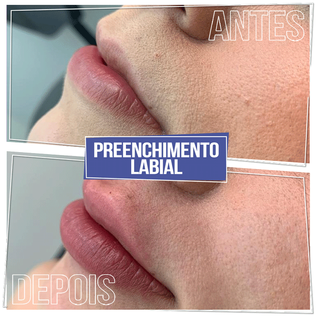 Resultado Preenchimento Labial - Brasília Sudoeste