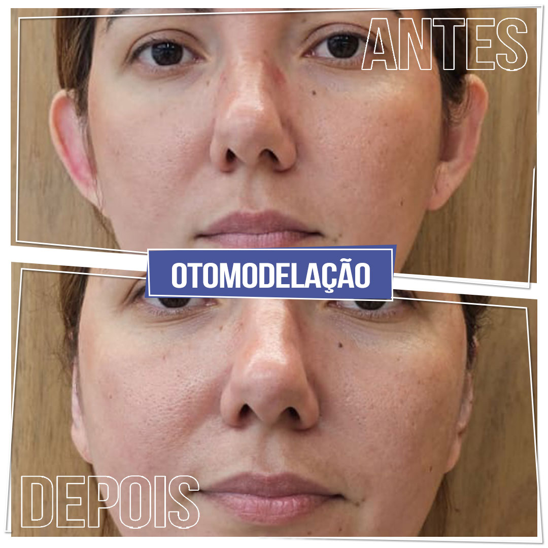 #Clínica de Estética em Brasília; #Clínica no Sudoeste; #Estética Avançada #Otomodelação; #Harmonização de Orelhas #orelhas de abano #otoplástia