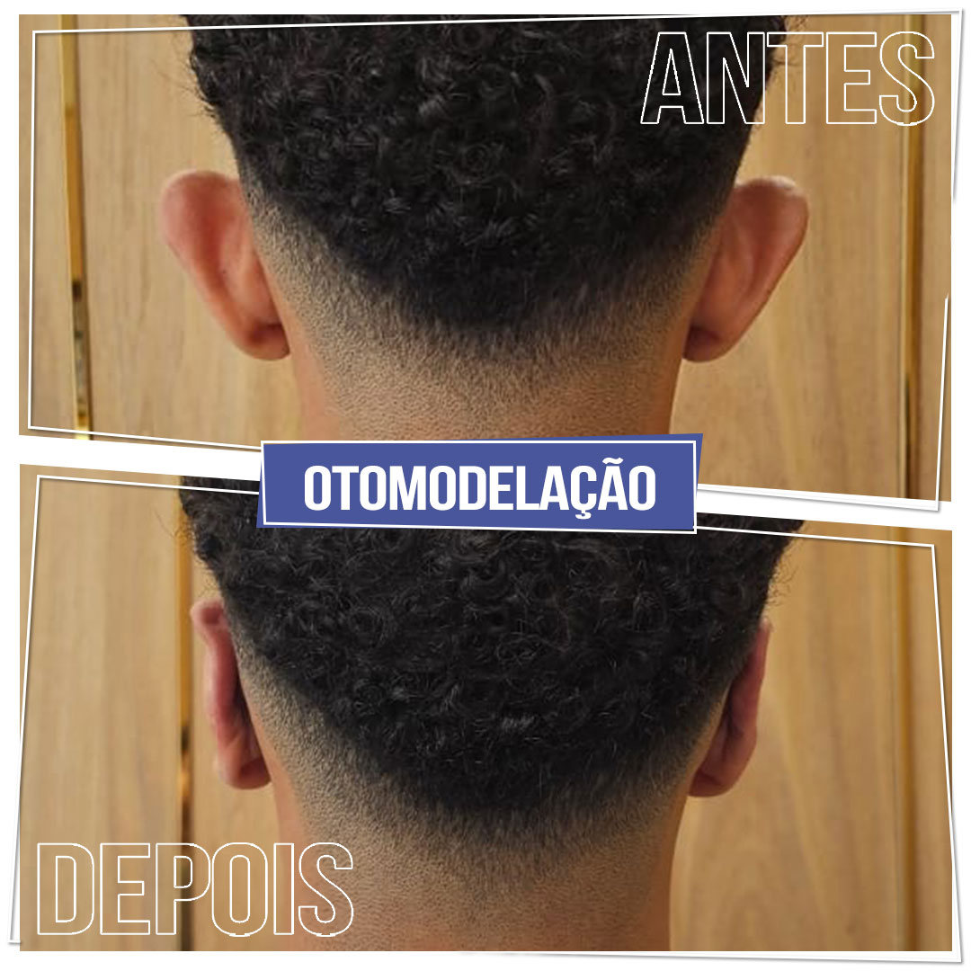 #Clínica de Estética em Brasília; #Clínica no Sudoeste; #Estética Avançada #Otomodelação; #Harmonização de Orelhas #orelhas de abano #otoplástia