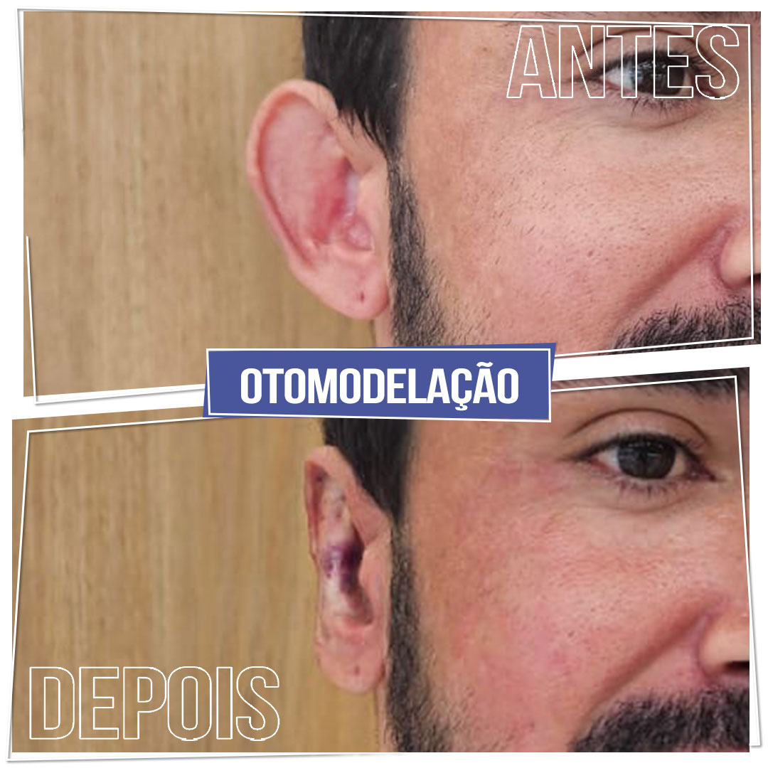 #Clínica de Estética em Brasília; #Clínica no Sudoeste; #Estética Avançada #Otomodelação; #Harmonização de Orelhas #orelhas de abano #otoplástia