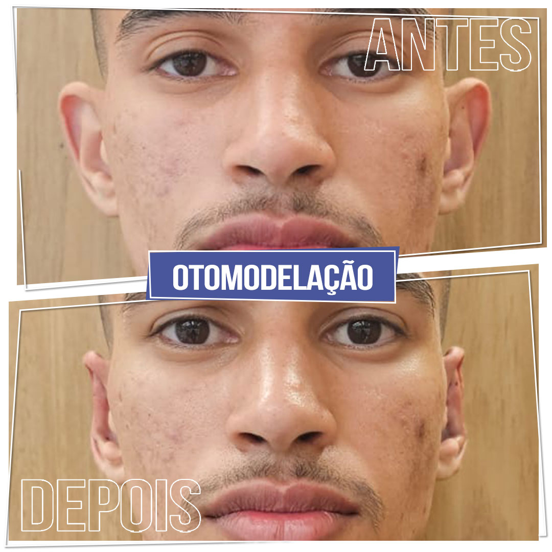 #Clínica de Estética em Brasília; #Clínica no Sudoeste; #Estética Avançada #Otomodelação; #Harmonização de Orelhas #orelhas de abano #otoplástia