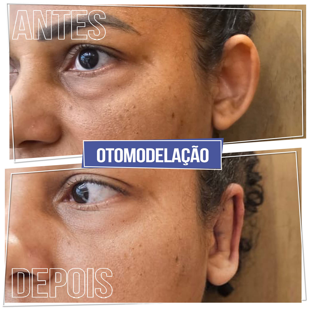 #Clínica de Estética em Brasília; #Clínica no Sudoeste; #Estética Avançada #Otomodelação; #Harmonização de Orelhas #orelhas de abano #otoplástia