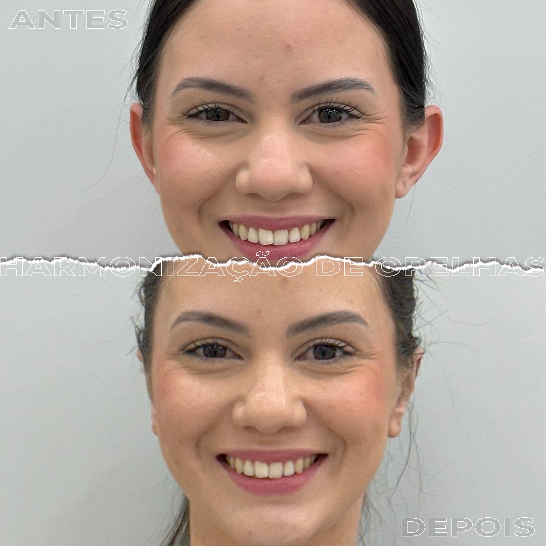 #Clínica de Estética em Brasília;
#Clínica no Sudoeste;
#Estética Avançada
#Otomodelação;
#Harmonização de Orelhas
#Otomodelação;
#orelhas de abano
#otoplastia fechada
#otoplastia