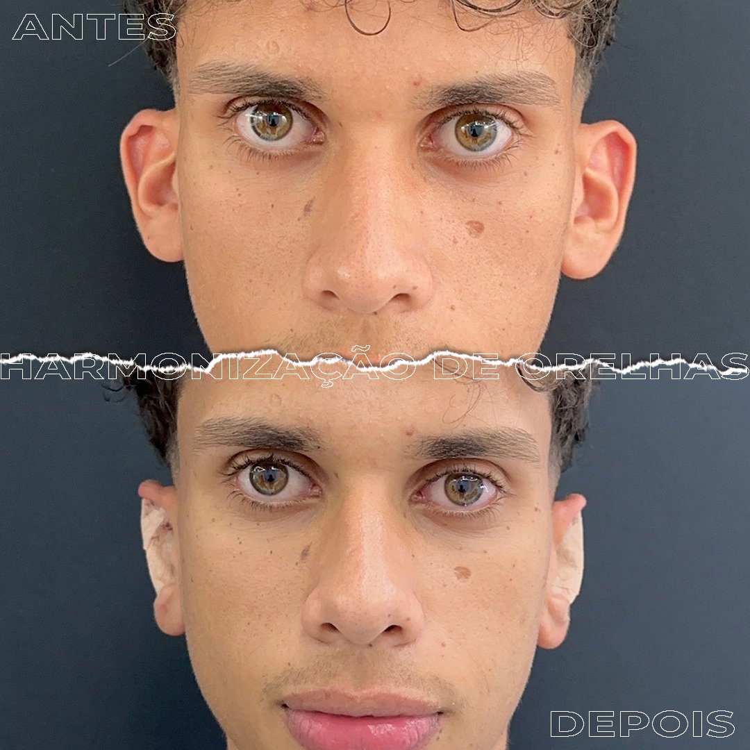 #Clínica de Estética em Brasília;
#Clínica no Sudoeste;
#Estética Avançada
#Otomodelação;
#Harmonização de Orelhas
#Otomodelação;
#orelhas de abano
#otoplastia fechada
#otoplastia