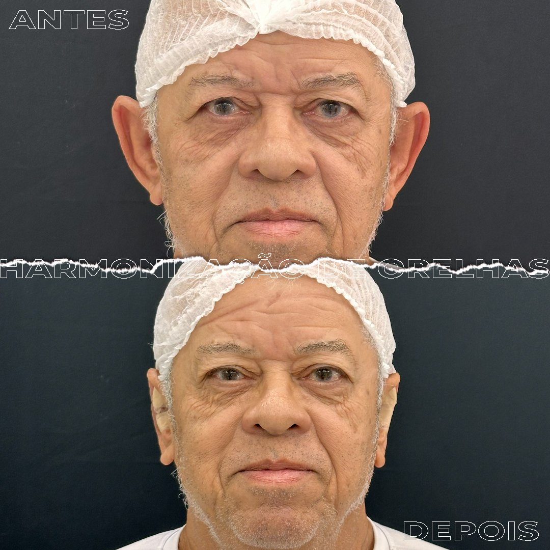 #Clínica de Estética em Brasília;
#Clínica no Sudoeste;
#Estética Avançada
#Otomodelação;
#Harmonização de Orelhas
#Otomodelação;
#orelhas de abano
#otoplastia fechada
#otoplastia