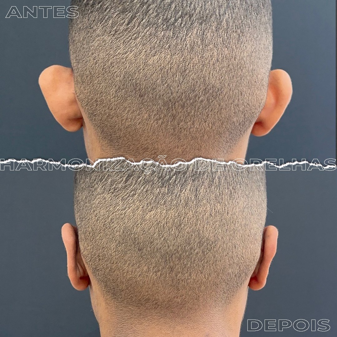 #Clínica de Estética em Brasília;
#Clínica no Sudoeste;
#Estética Avançada
#Otomodelação;
#Harmonização de Orelhas
#Otomodelação;
#orelhas de abano
#otoplastia fechada
#otoplastia