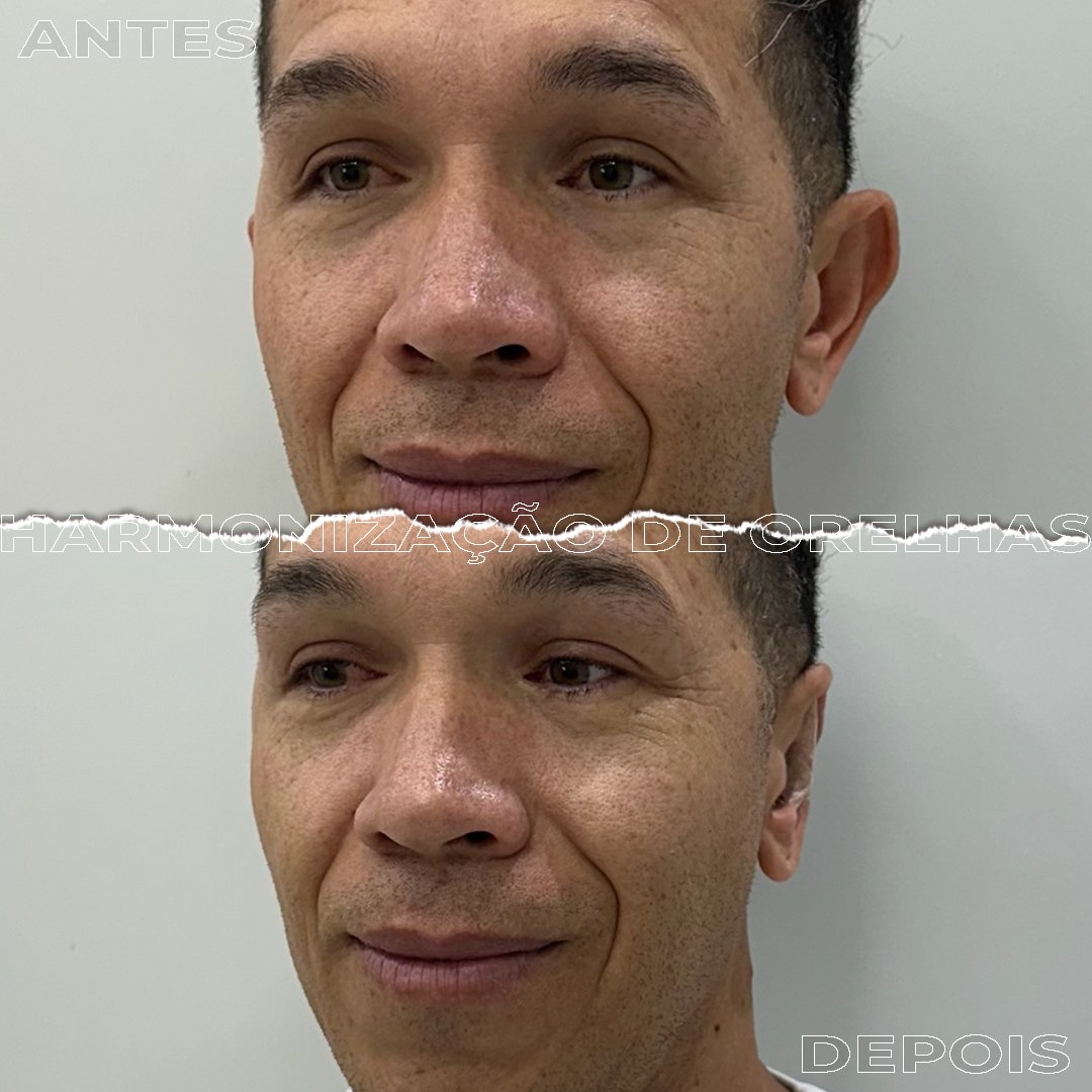 #Clínica de Estética em Brasília;
#Clínica no Sudoeste;
#Estética Avançada
#Otomodelação;
#Harmonização de Orelhas
#Otomodelação;
#orelhas de abano
#otoplastia fechada
#otoplastia