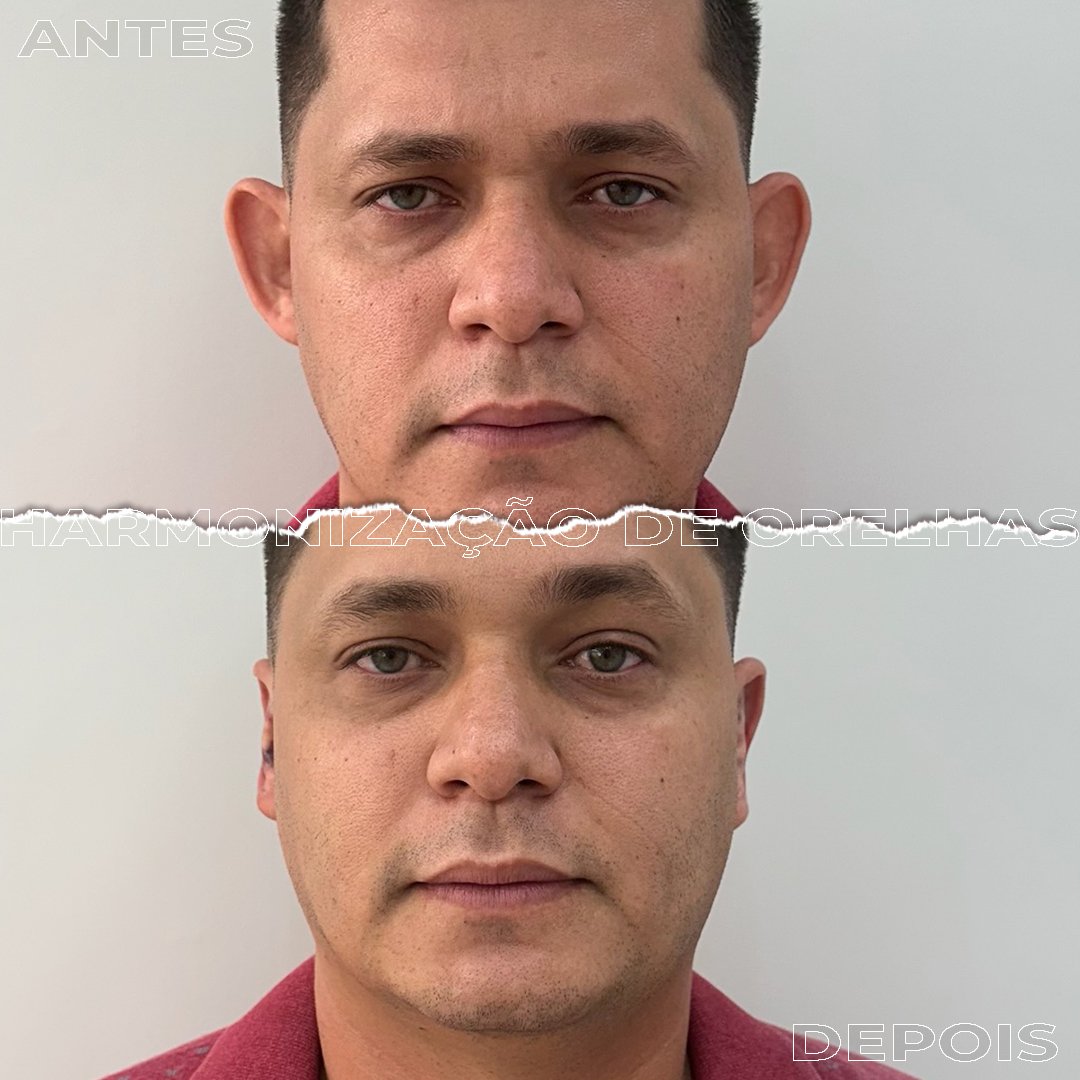 #Clínica de Estética em Brasília;
#Clínica no Sudoeste;
#Estética Avançada
#Otomodelação;
#Harmonização de Orelhas
#Otomodelação;
#orelhas de abano
#otoplastia fechada
#otoplastia