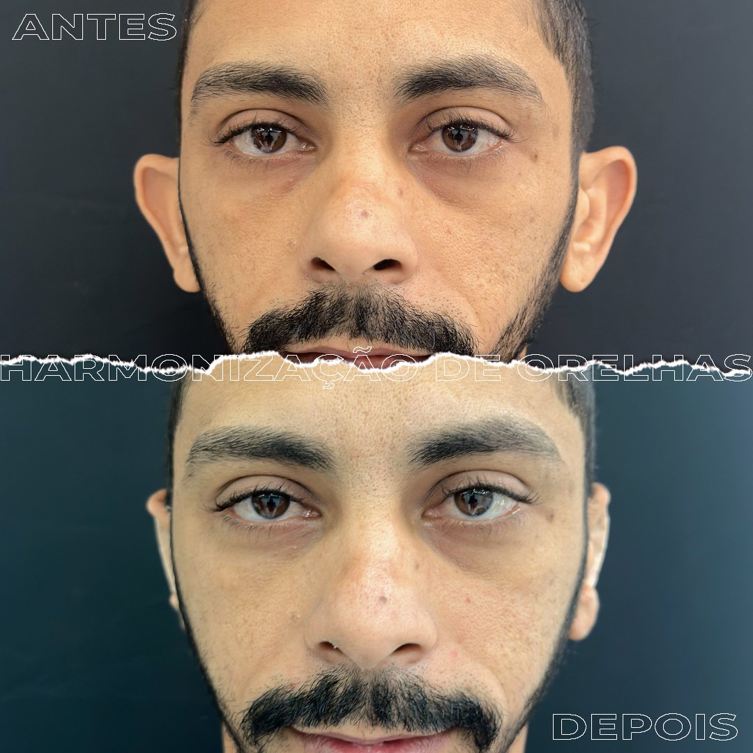 #Clínica de Estética em Brasília;
#Clínica no Sudoeste;
#Estética Avançada
#Otomodelação;
#Harmonização de Orelhas
#Otomodelação;
#orelhas de abano
#otoplastia fechada
#otoplastia